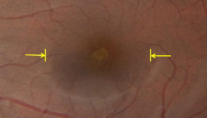 damaged retina in color